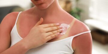 Izgorjeli ste na suncu? Evo brzih rješenja za obnovu kože, a gotovo sve imate u kući